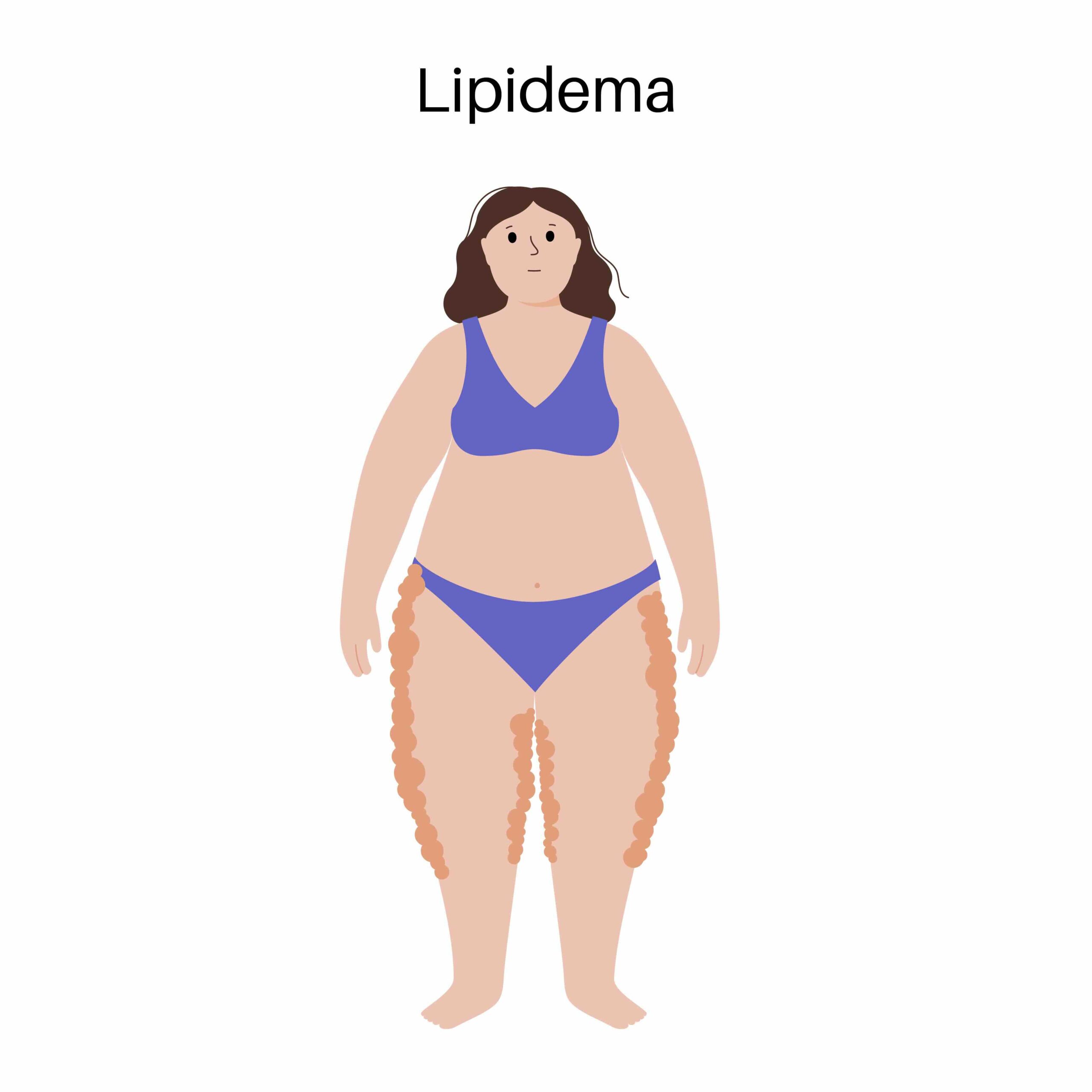 Lipedema: cos’è e come si cura. L’influenza dell’alimentazione